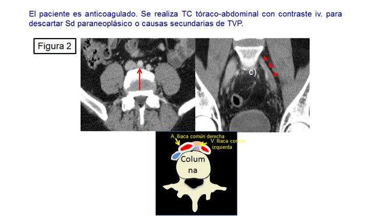 Tratamiento endovascular en el síndrome de may-thurner mediante recanalización y nuevas endoprótesis venosas — diapositiva 3