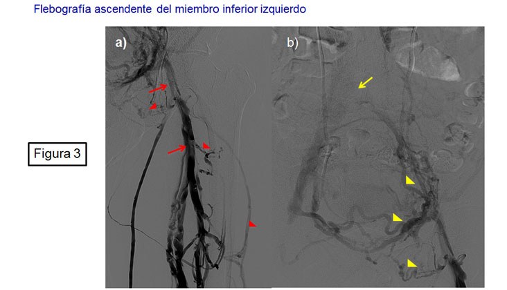 Tratamiento endovascular en el síndrome de may-thurner mediante recanalización y nuevas endoprótesis venosas — diapositiva 4