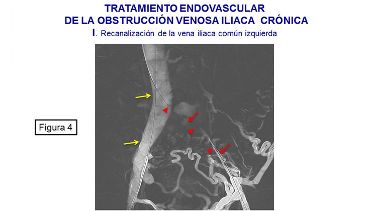 Tratamiento endovascular en el síndrome de may-thurner mediante recanalización y nuevas endoprótesis venosas — diapositiva 5