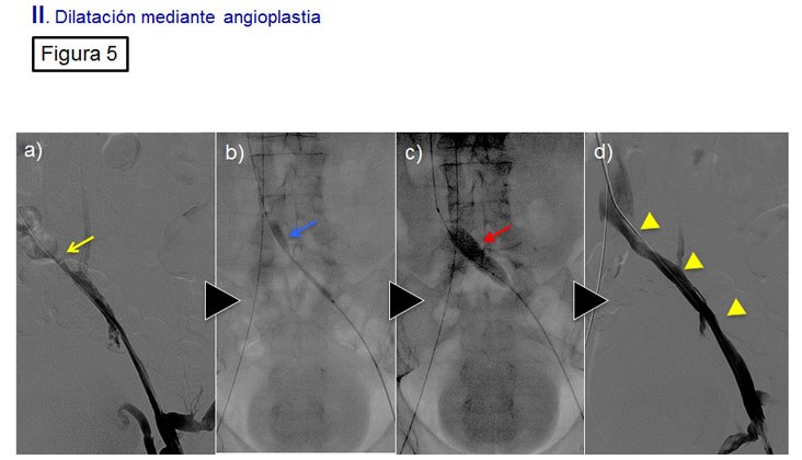 Tratamiento endovascular en el síndrome de may-thurner mediante recanalización y nuevas endoprótesis venosas — diapositiva 6