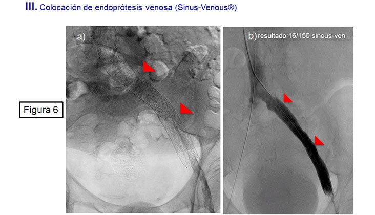 Tratamiento endovascular en el síndrome de may-thurner mediante recanalización y nuevas endoprótesis venosas — diapositiva 7