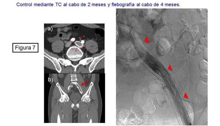 Tratamiento endovascular en el síndrome de may-thurner mediante recanalización y nuevas endoprótesis venosas — diapositiva 8