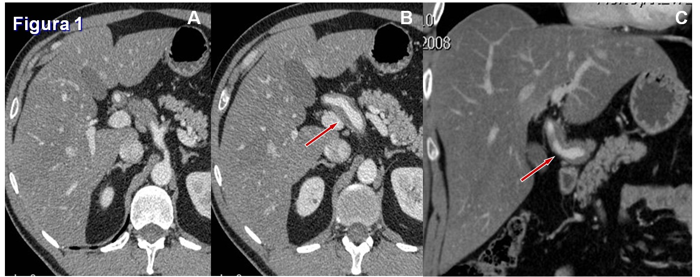 Utilidad del stent modulador de flujo en un caso de aneurisma de la arteria hepática — diapositiva 2