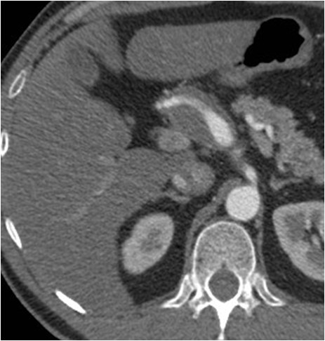 Utilidad del stent modulador de flujo en un caso de aneurisma de la arteria hepática — diapositiva 5