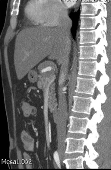 Utilidad del stent modulador de flujo en un caso de aneurisma de la arteria hepática — diapositiva 7