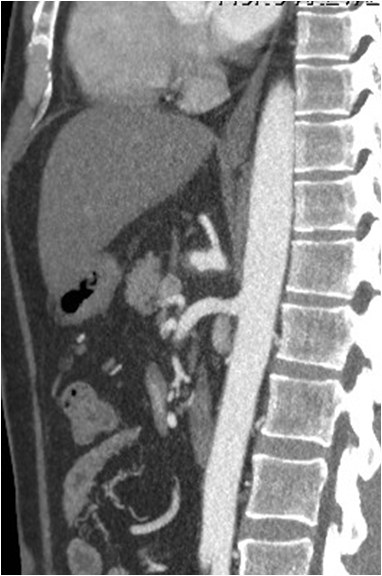 Utilidad del stent modulador de flujo en un caso de aneurisma de la arteria hepática — diapositiva 9