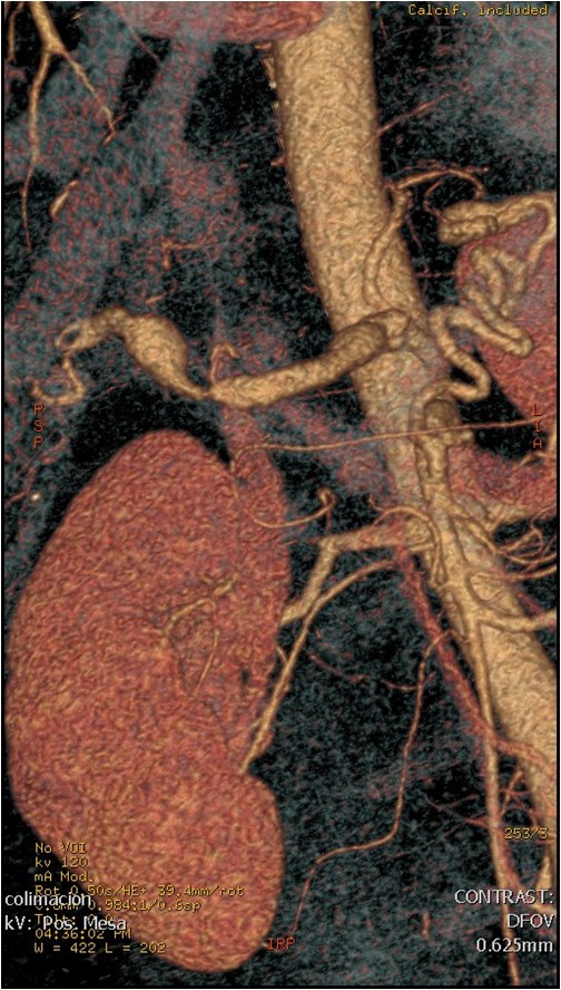 Utilidad del stent modulador de flujo en un caso de aneurisma de la arteria hepática — diapositiva 10