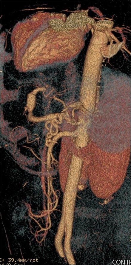 Utilidad del stent modulador de flujo en un caso de aneurisma de la arteria hepática — diapositiva 11