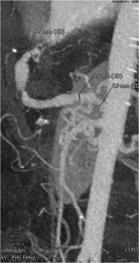 Utilidad del stent modulador de flujo en un caso de aneurisma de la arteria hepática — diapositiva 12