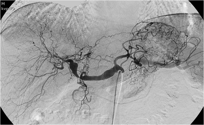 Utilidad del stent modulador de flujo en un caso de aneurisma de la arteria hepática — diapositiva 13