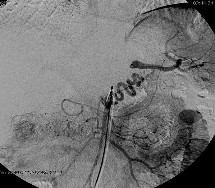 Utilidad del stent modulador de flujo en un caso de aneurisma de la arteria hepática — diapositiva 14