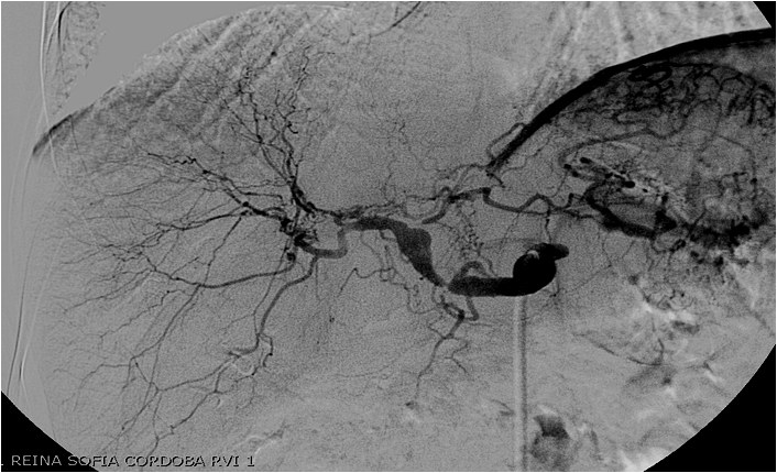 Utilidad del stent modulador de flujo en un caso de aneurisma de la arteria hepática — diapositiva 15