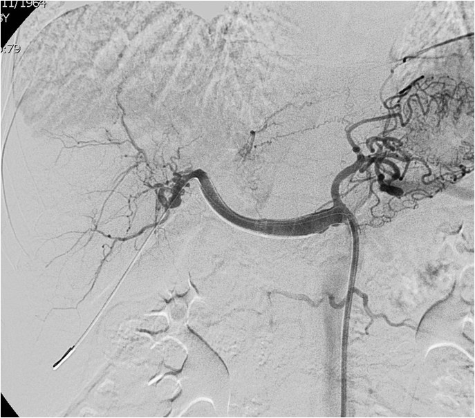 Utilidad del stent modulador de flujo en un caso de aneurisma de la arteria hepática — diapositiva 16