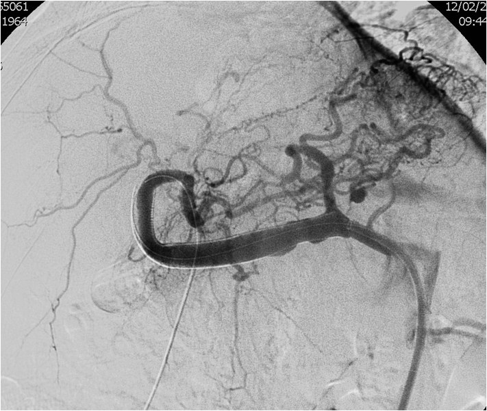 Utilidad del stent modulador de flujo en un caso de aneurisma de la arteria hepática — diapositiva 17