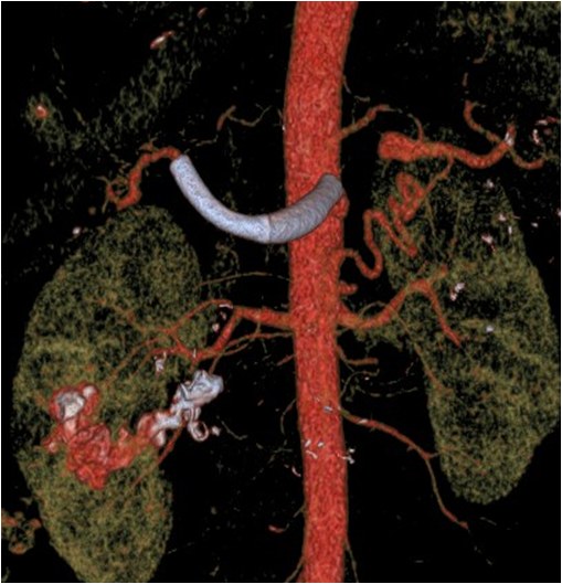 Utilidad del stent modulador de flujo en un caso de aneurisma de la arteria hepática — diapositiva 19