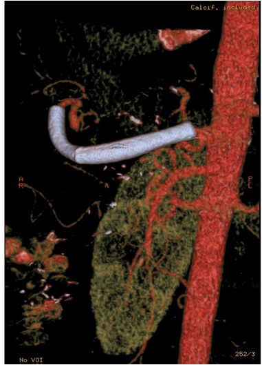 Utilidad del stent modulador de flujo en un caso de aneurisma de la arteria hepática — diapositiva 20
