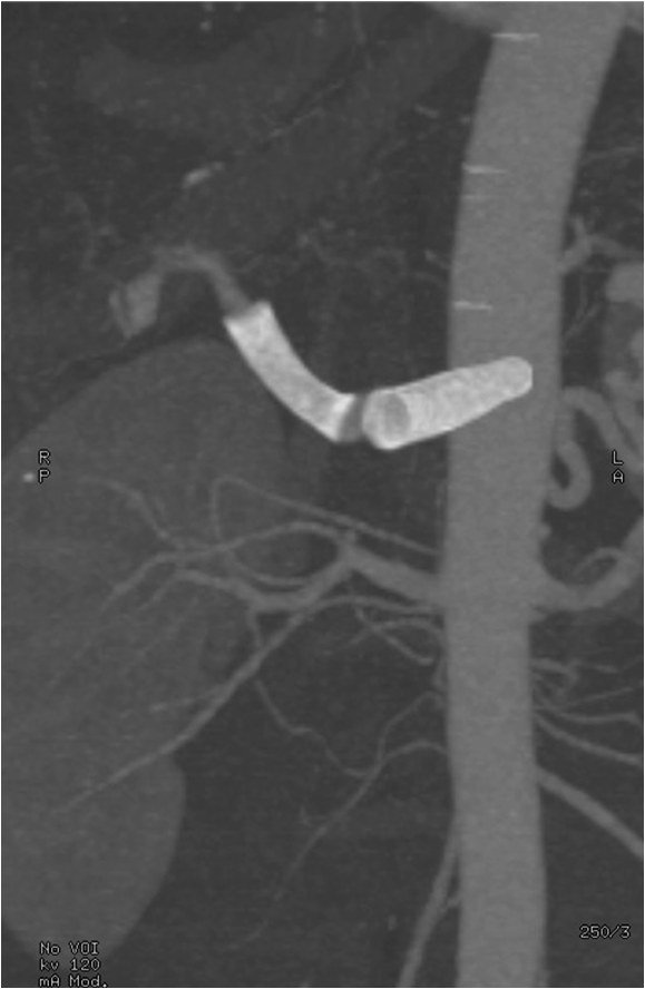 Utilidad del stent modulador de flujo en un caso de aneurisma de la arteria hepática — diapositiva 24