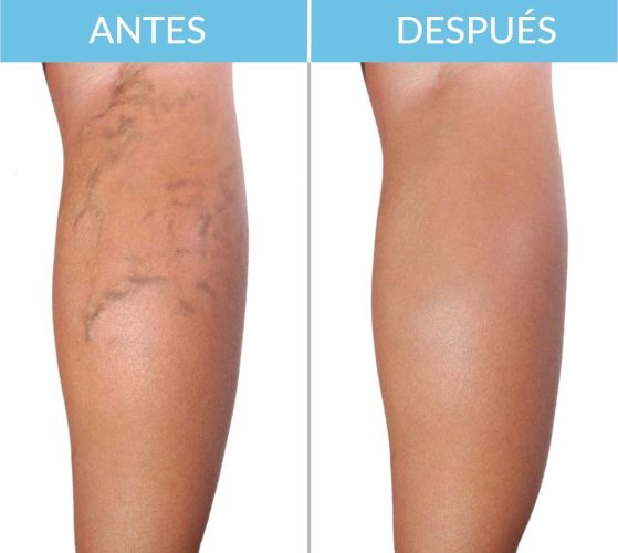 Varices-piernas_antes-y-despues.jpg